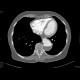 Dissecting aneurysm of the thoracic aorta, thrombosis of false lumen: CT - Computed tomography